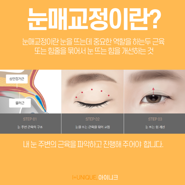 피곤해 보이는 눈을 다시 또렷하게 안검하수 잘하는곳 관련 이미지 3