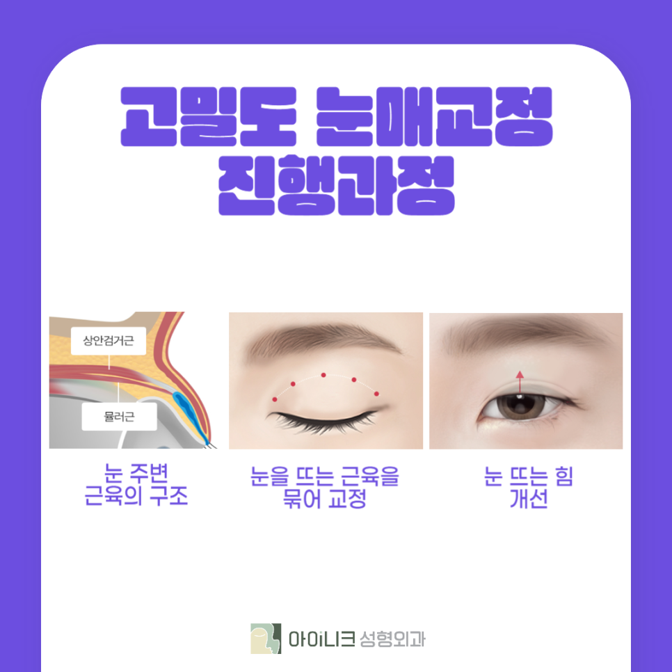 40대안검하수 고려하고 있다면 관련 이미지 5