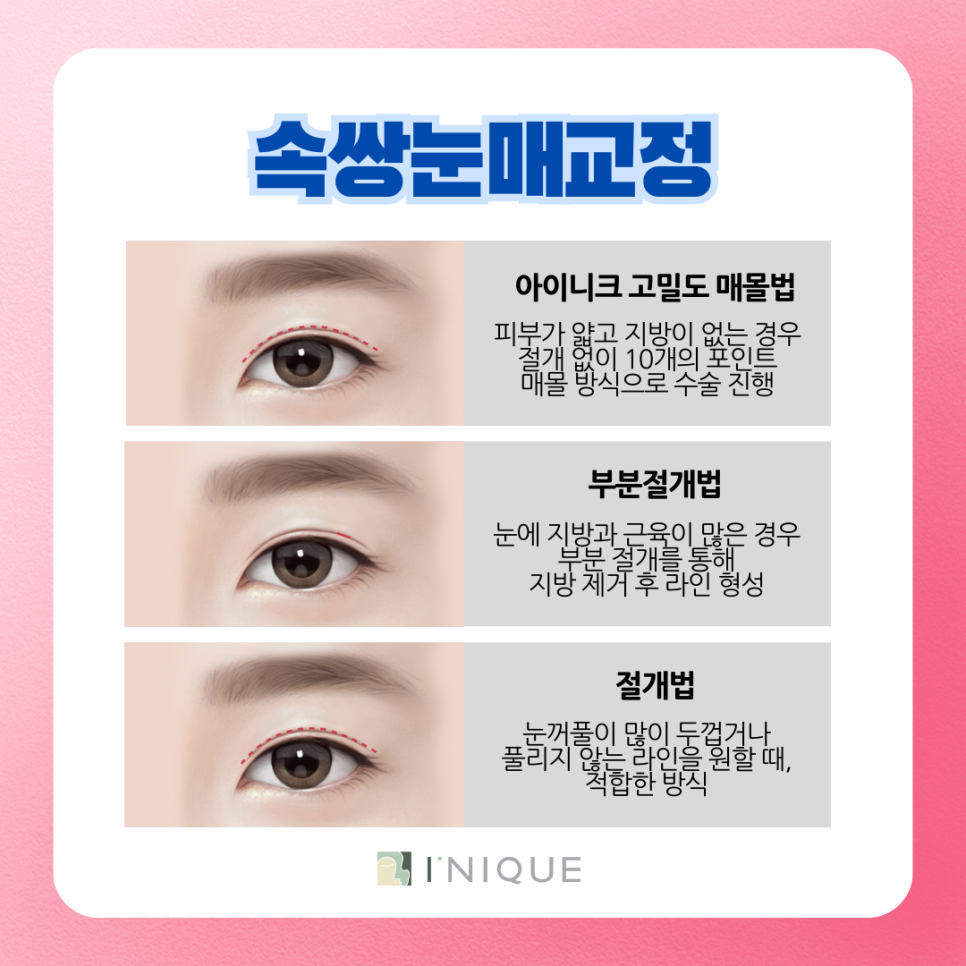 Apgujeong Male Eye Surgery: What’s the Difference from Women’s? image 6
