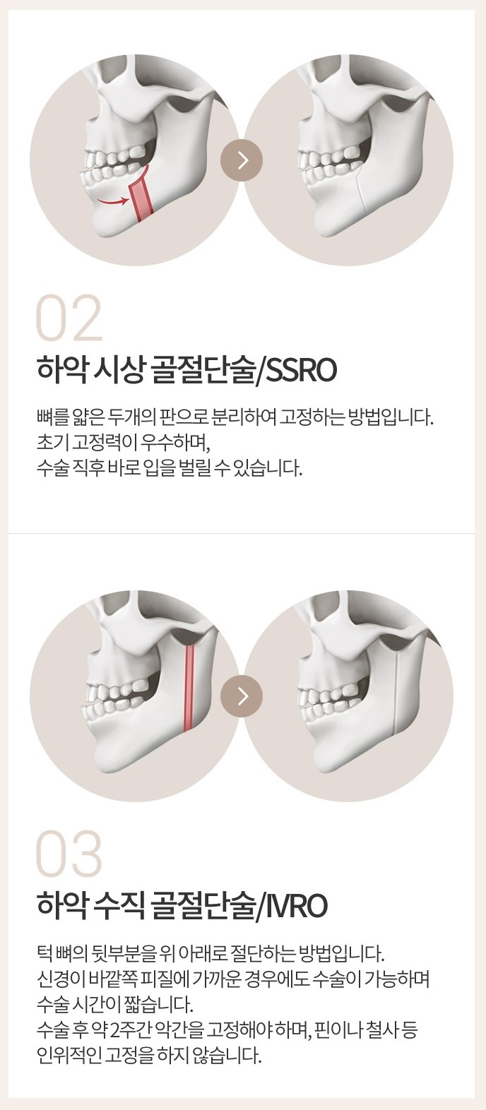 양악수술통증 없이 안전하게 관련 이미지 3