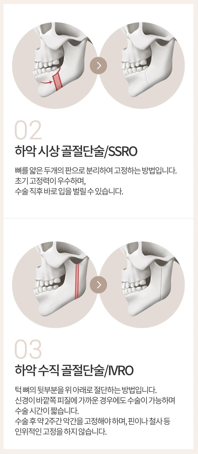 양악수술회복기간 고민 없는 아이니크에서! 관련 이미지 3