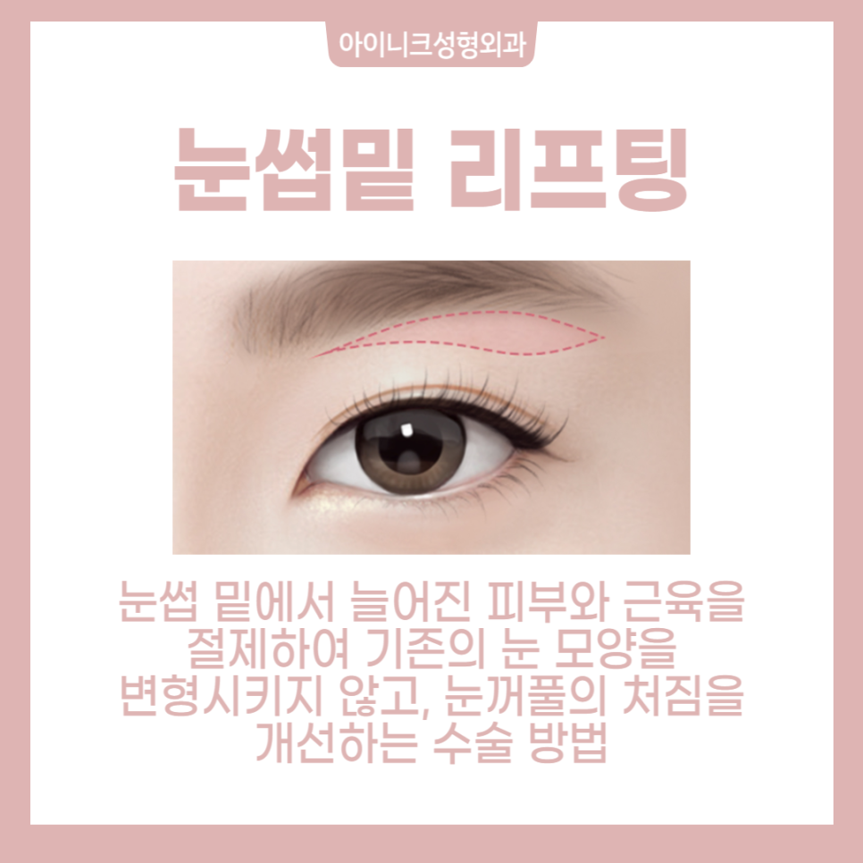 동안눈성형, 제대로 하고 싶다면 관련 이미지 3