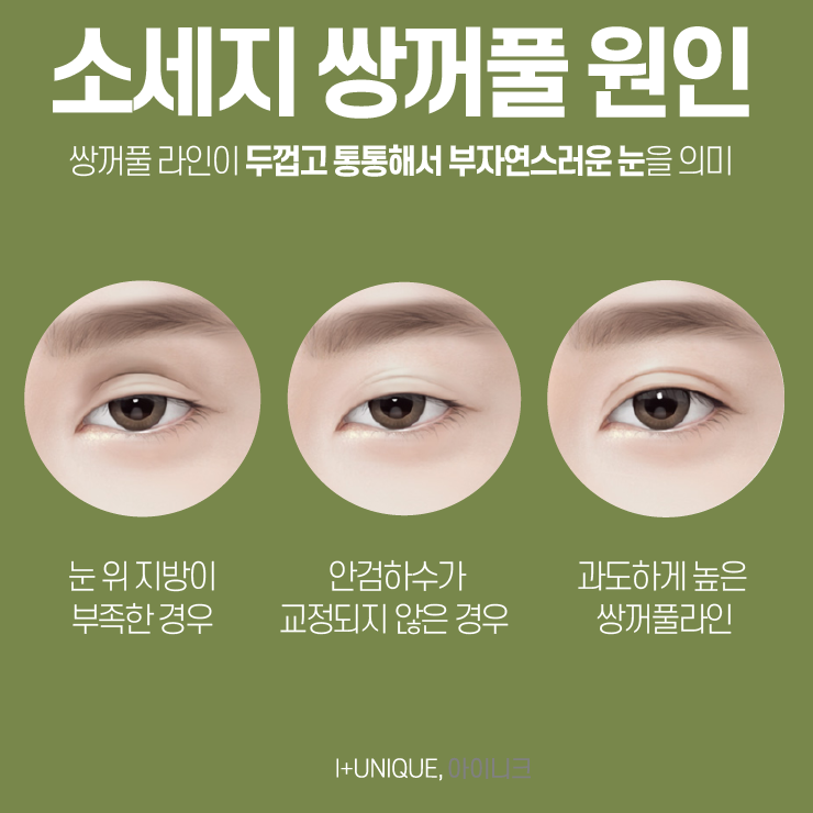 첫 수술만큼 중요한 눈재수술잘하는병원 고르기, 더이상 고민말고 아이니크로 관련 이미지 2