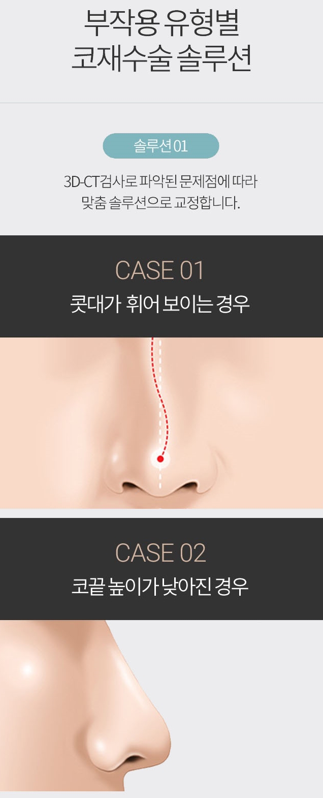 코재건수술 두 번의 실수는 없다! 관련 이미지 3