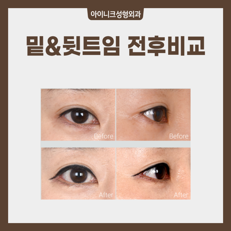 180도 이미지 변신? 압구정트임 수술 관련 이미지 6
