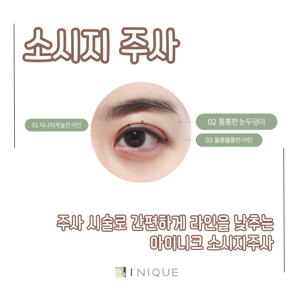 쌍꺼풀재수술성공 하고 싶다면 관련 이미지 5