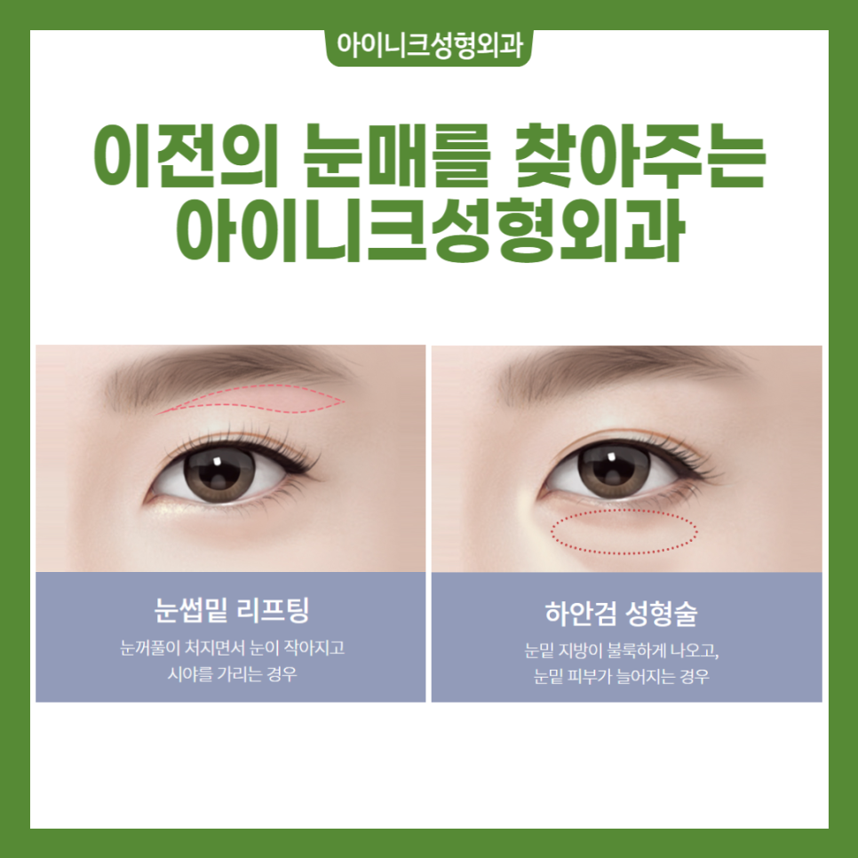 서울중년눈성형 다시 20대의 눈매로 관련 이미지 2
