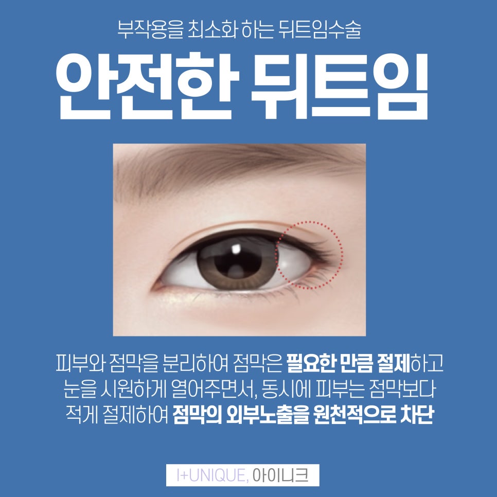 아이니크성형외과와 함께 트임종류 알아보자 관련 이미지 4