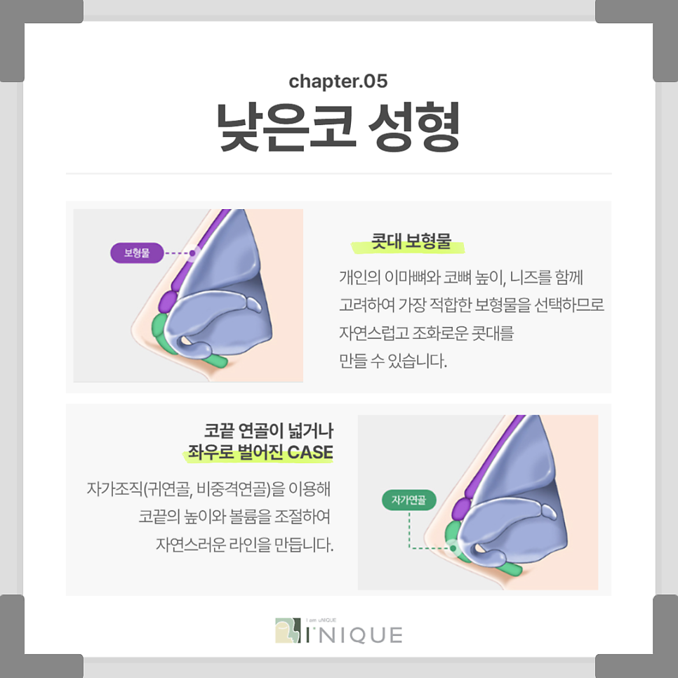Custom Rhinoplasty in Harmony With My Face image 5