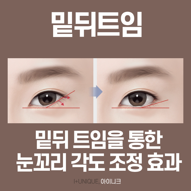뒤트임성형 이제 더 이상 고민하지 마세요! 관련 이미지 4