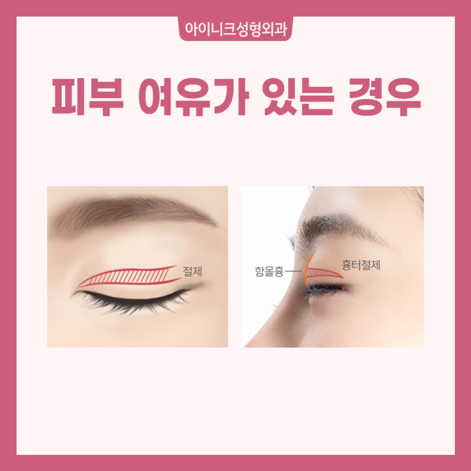 Take a Careful Look at an Apgujeong Eye Revision Surgery Clinic! image 3