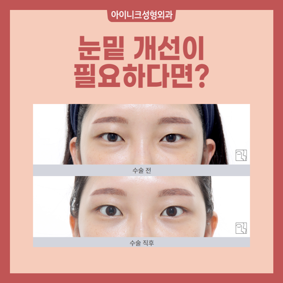 A New Idea! Under-Eye Surgery Center, Youth & Young! image 5