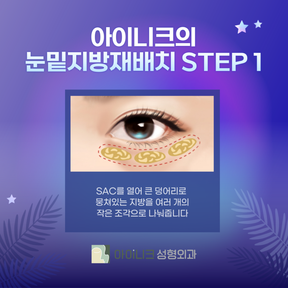 눈밑지방재배치추천병원 제대로 선택하려면? 관련 이미지 4