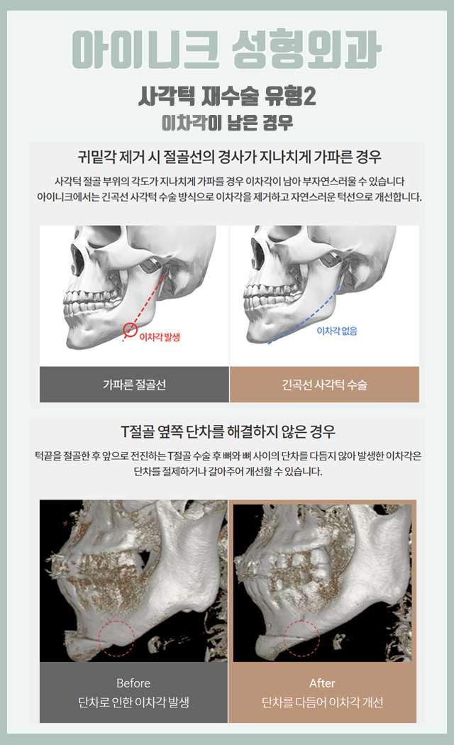 사각턱재건 두 번의 실패 없이 정확한 원인 해결! 관련 이미지 5