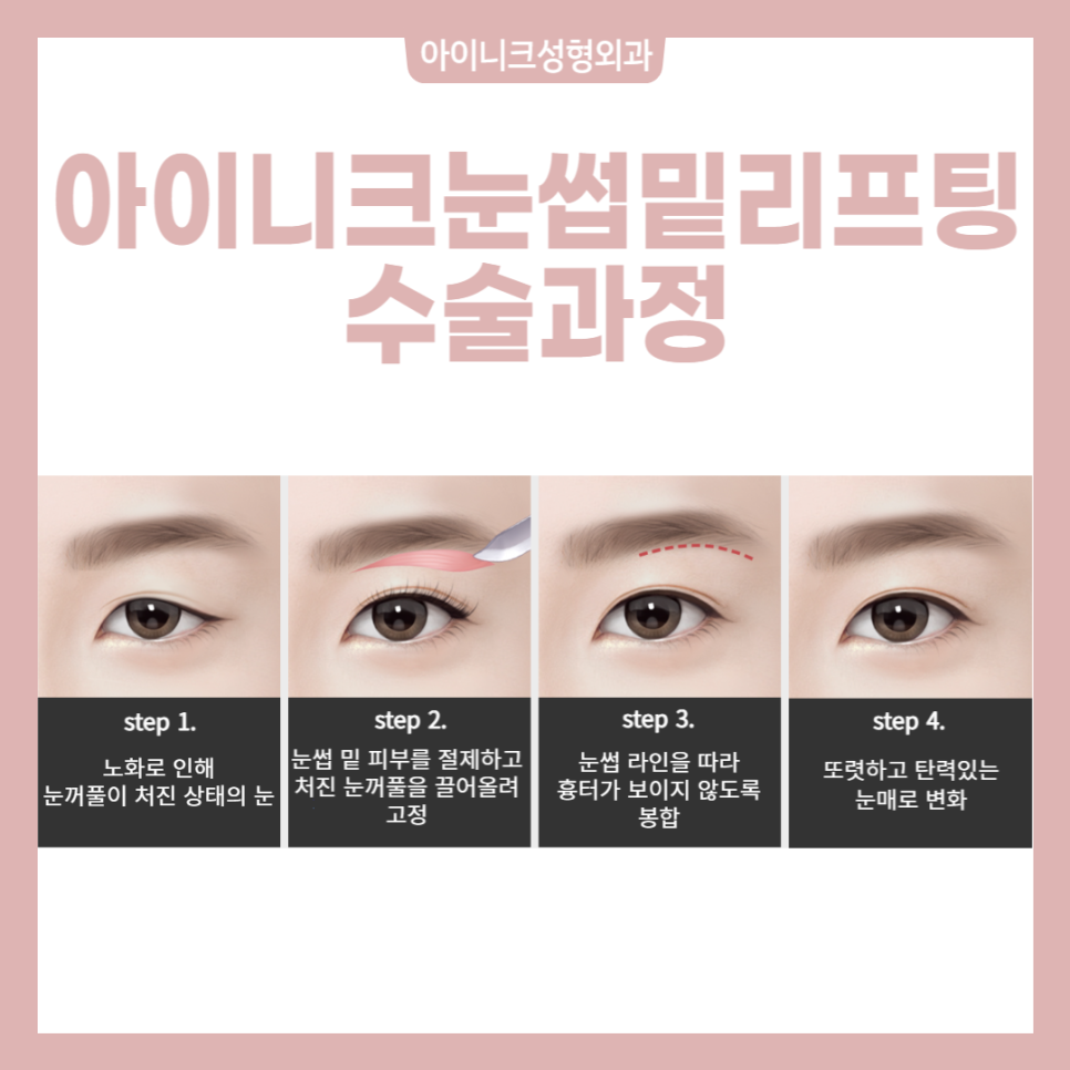 동안눈성형, 제대로 하고 싶다면 관련 이미지 4