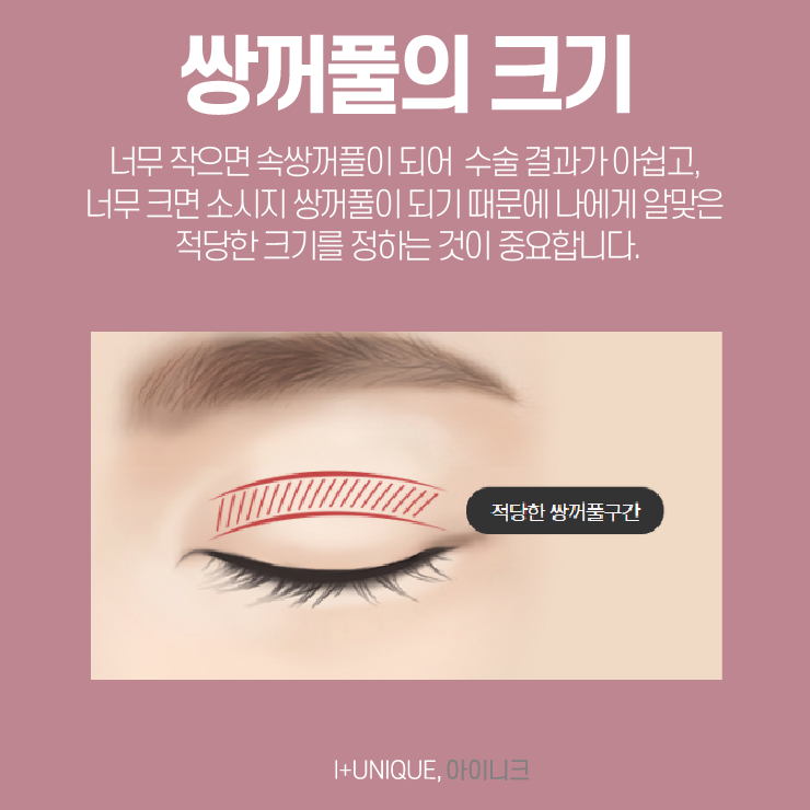 눈수술잘하는곳을 알아보려면 아이니크성형외과와 이것부터 알아보자 관련 이미지 3