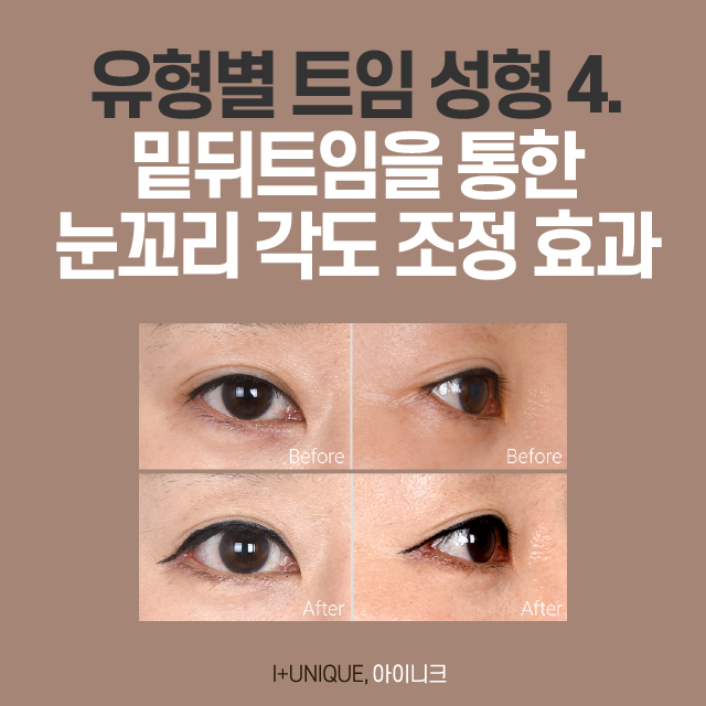 트임 성형의 종류, 그리고 트임 후기! 관련 이미지 5