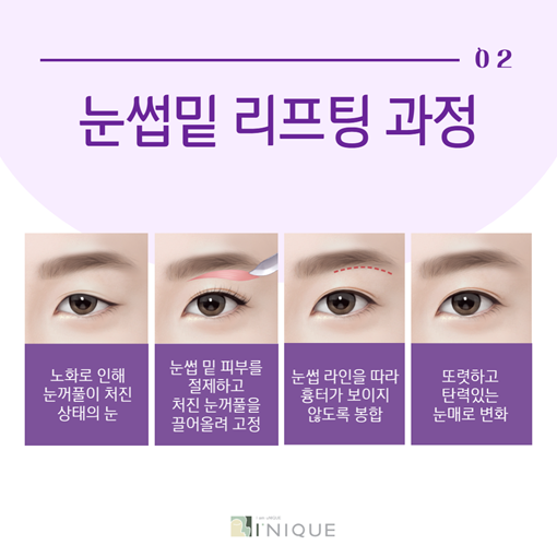 Restoring a Lively Eye Appearance with Drooping Eye Surgery image 3