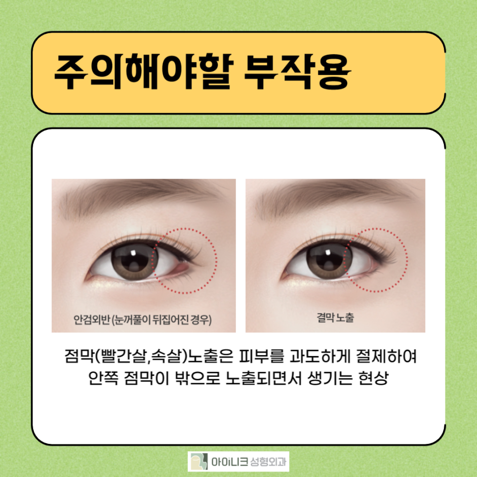눈꼬리내리는수술로 강아지상 만들기 관련 이미지 3