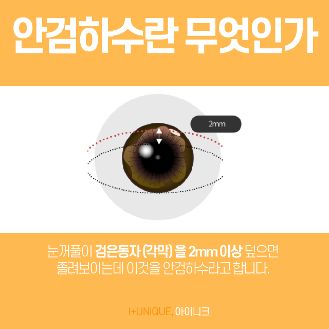 피곤해 보이는 눈을 다시 또렷하게 안검하수 잘하는곳 관련 이미지 2