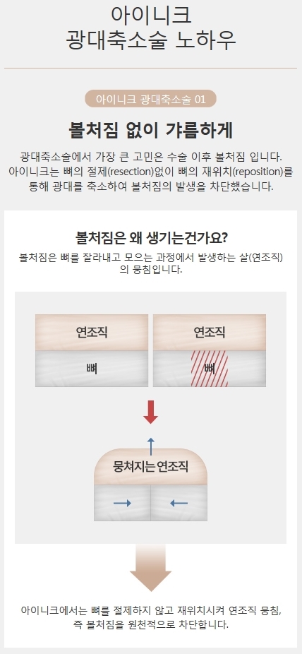 광대뼈축소부작용 없이 자연스러운 내 얼굴! 관련 이미지 3