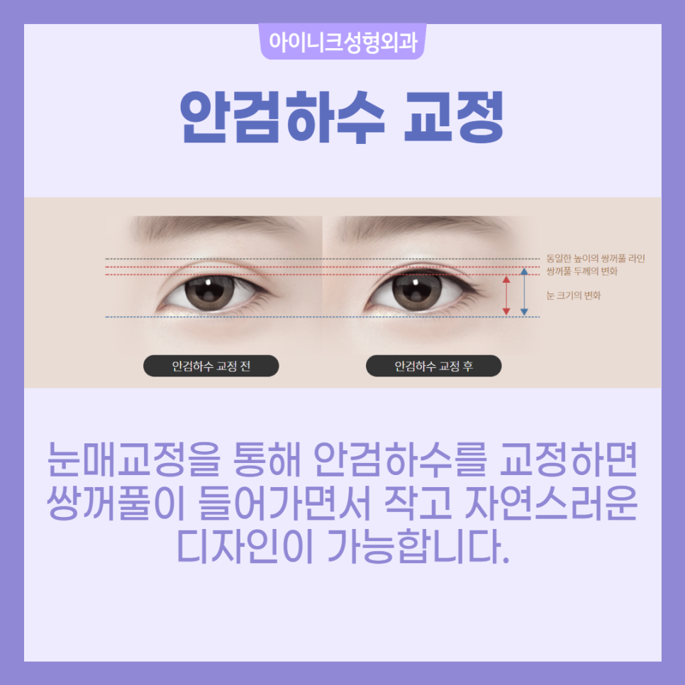 소세지쌍꺼풀 재수술 걱정 마세요! 관련 이미지 5