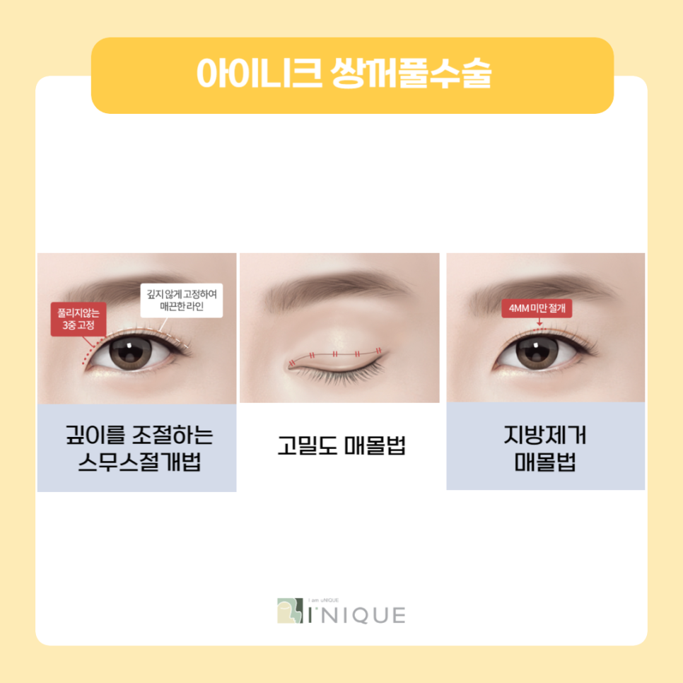 The Best Place for Double Eyelid Surgery for Women Is Right Here! image 2