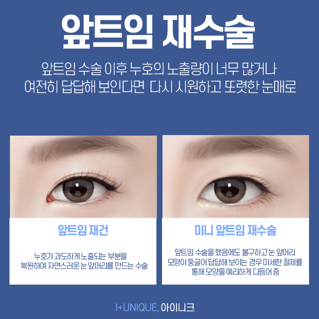 눈재수술성형외과 고를 때 이것만 알아주세요! 관련 이미지 6