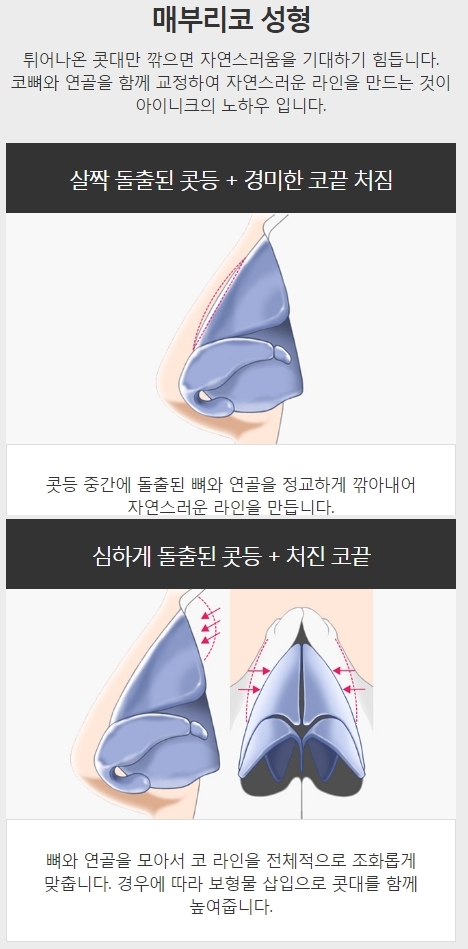 여자매부리코수술 특징에 맞는 유형별 코성형! 관련 이미지 5