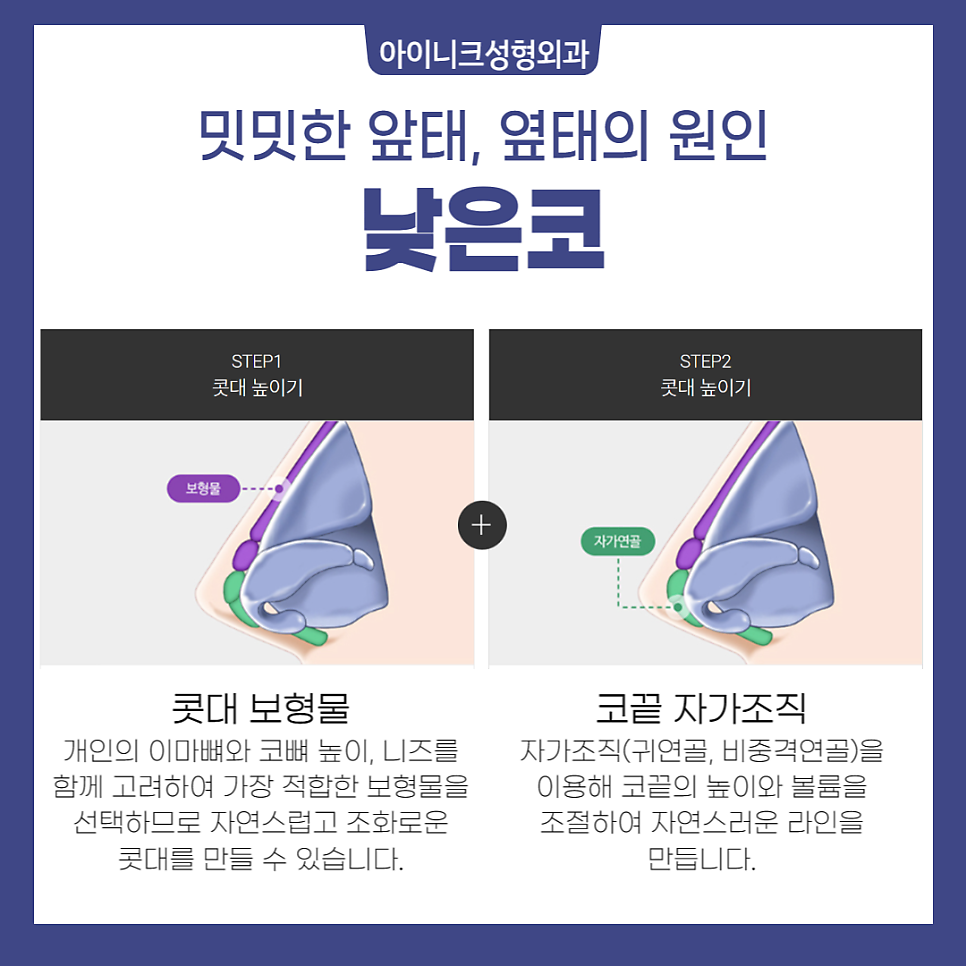 투박한 인상을 바꾸고 싶다면, 복코성형! 관련 이미지 4