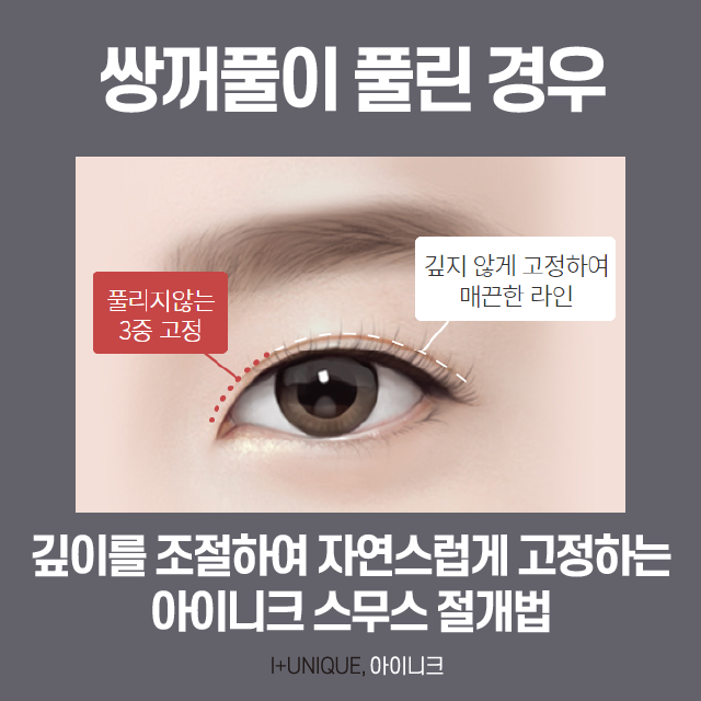 쌍꺼풀 여러겹 해결하고 싶다면? 관련 이미지 3