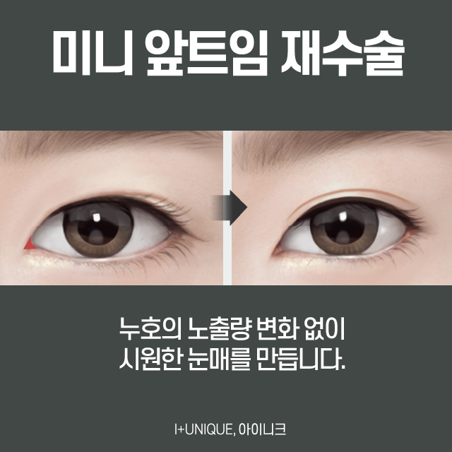 앞트임재수술 이번엔 제대로! 관련 이미지 4