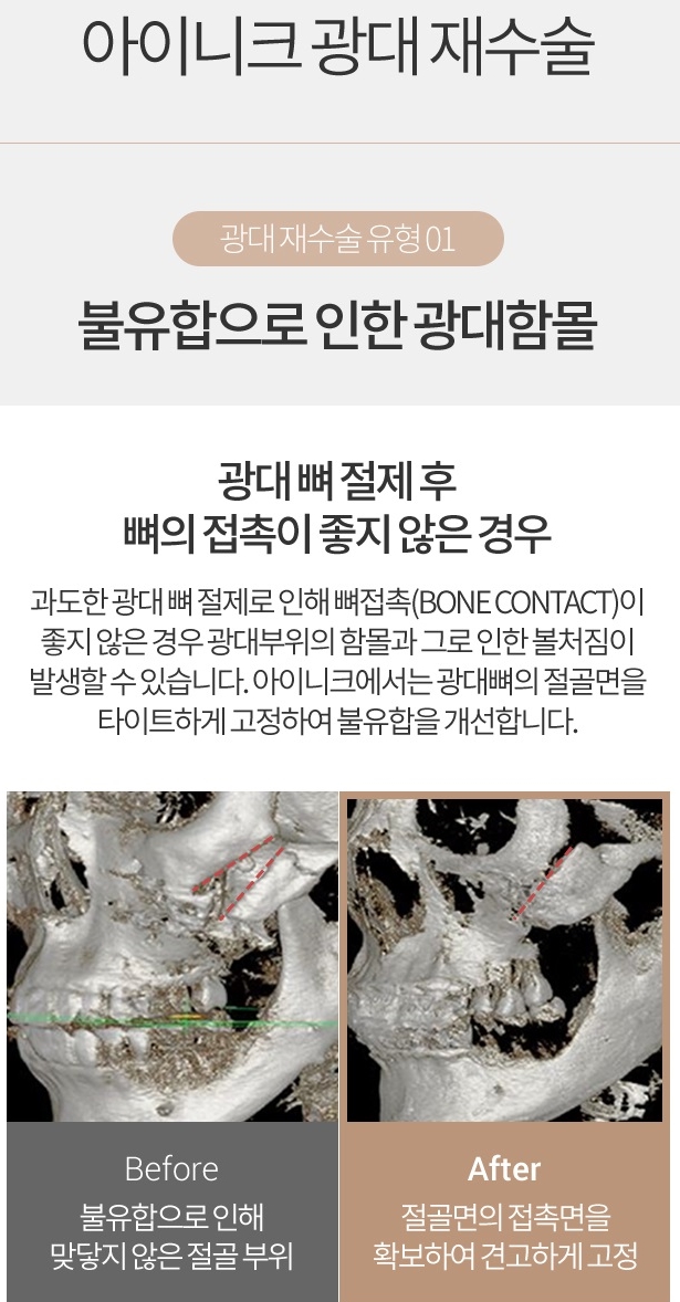 남자안면윤곽수술비용도 아이니크에서 알아보자! 관련 이미지 6