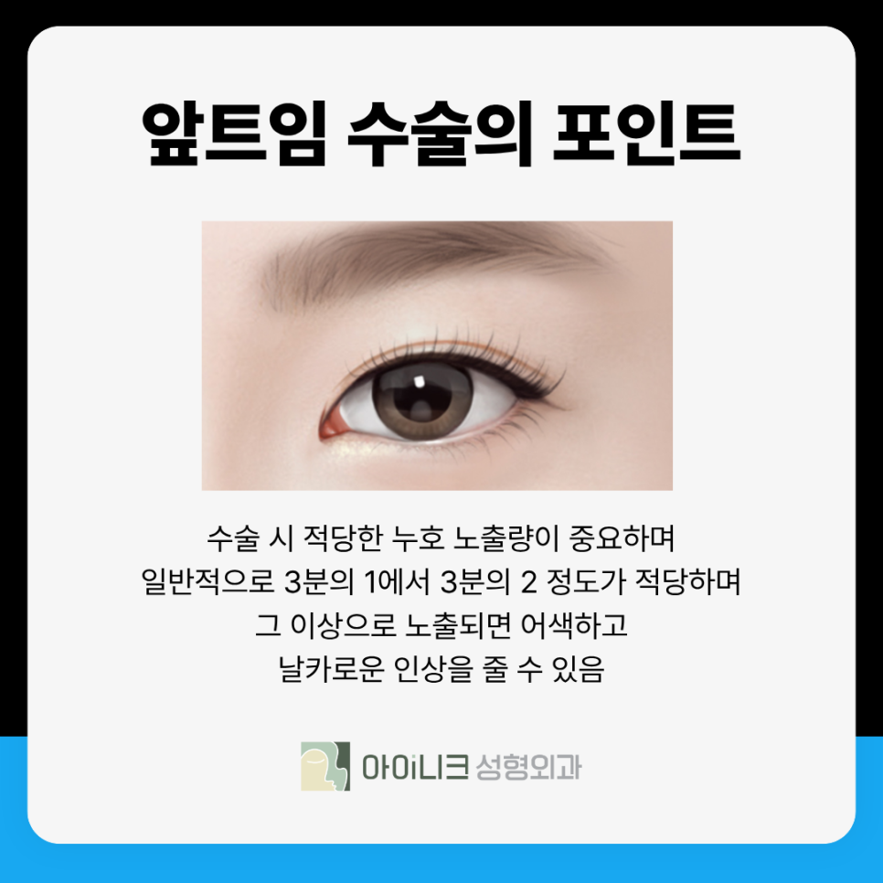 Revision Eye Surgery Clinic: What Can I Do About a Harsh Look Caused by Excessive Epicanthoplasty? image 5