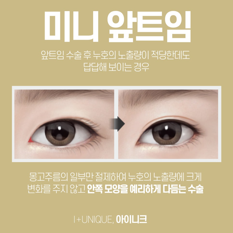 앞트임성형도 자연스럽게 아이니크성형외과에서 관련 이미지 6