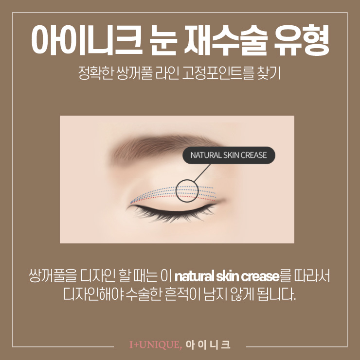 눈재수술을 원한다면 아이니크성형외과에서 확실하게 관련 이미지 3