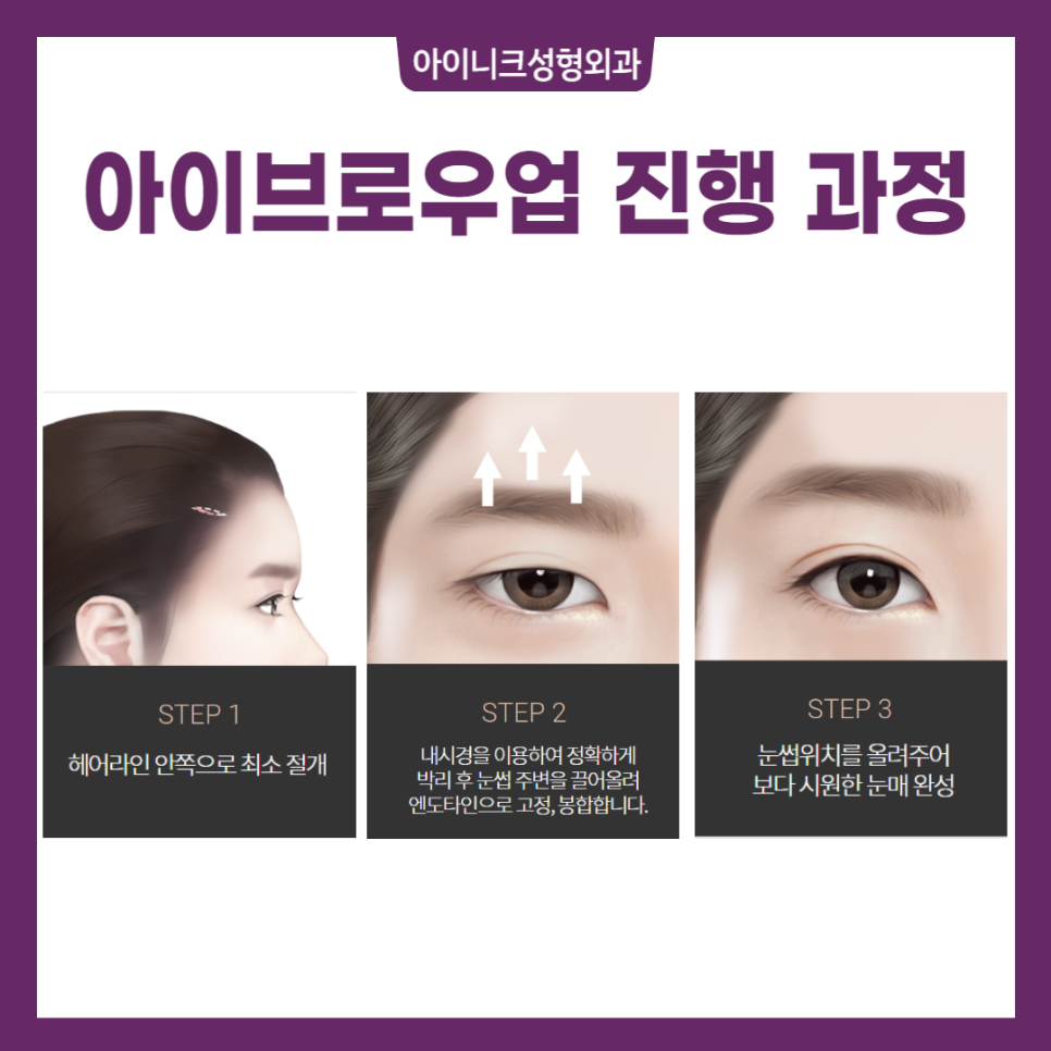 눈썹올림술로 주름 개선과 눈매교정을 동시에! 관련 이미지 4