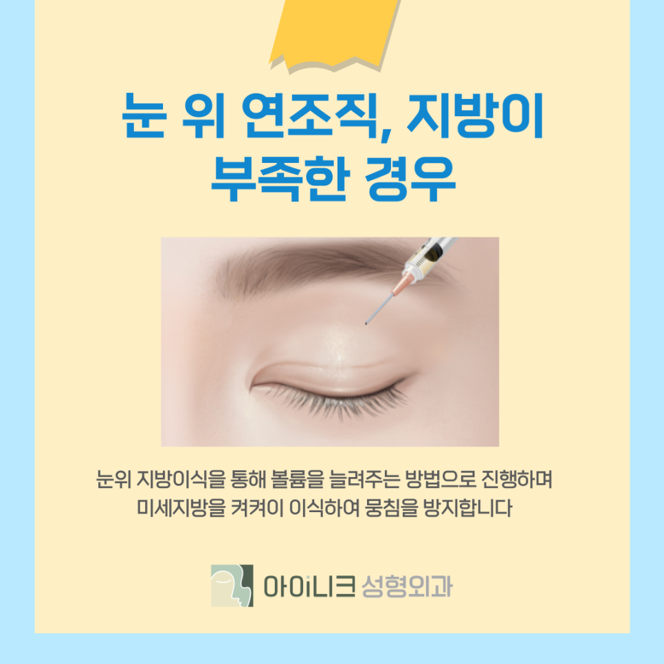 쌍꺼풀 재수술 기간 언제부터 가능한가요? 관련 이미지 12