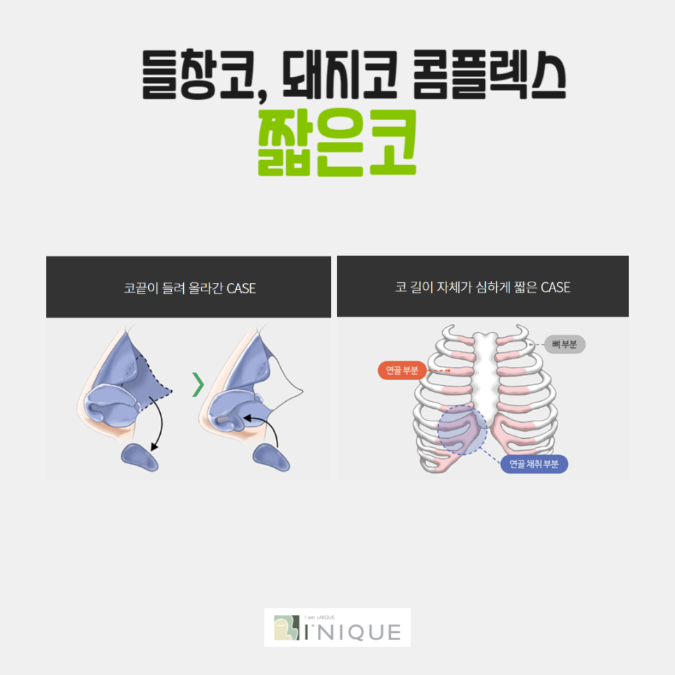 흰코성형이 고민이라면 주목! 관련 이미지 5