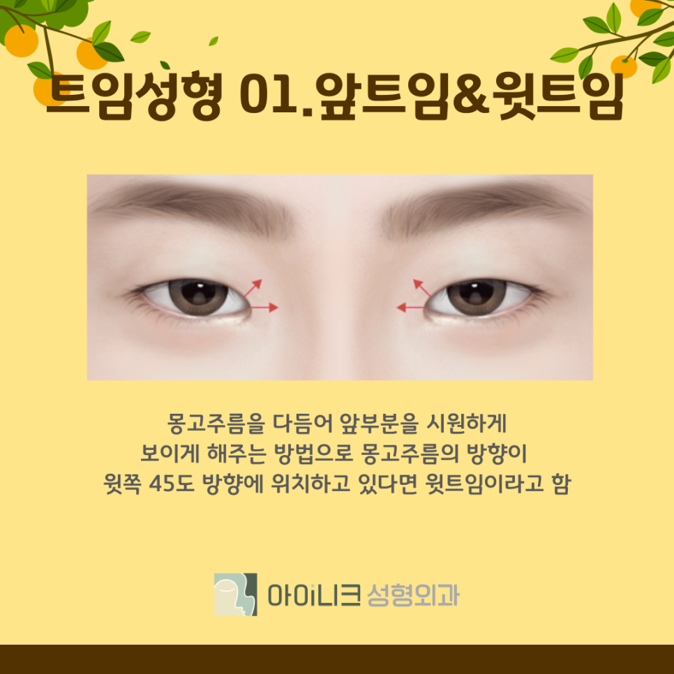 눈트임 수술 종류 나에게 맞는 방법은? 관련 이미지 5