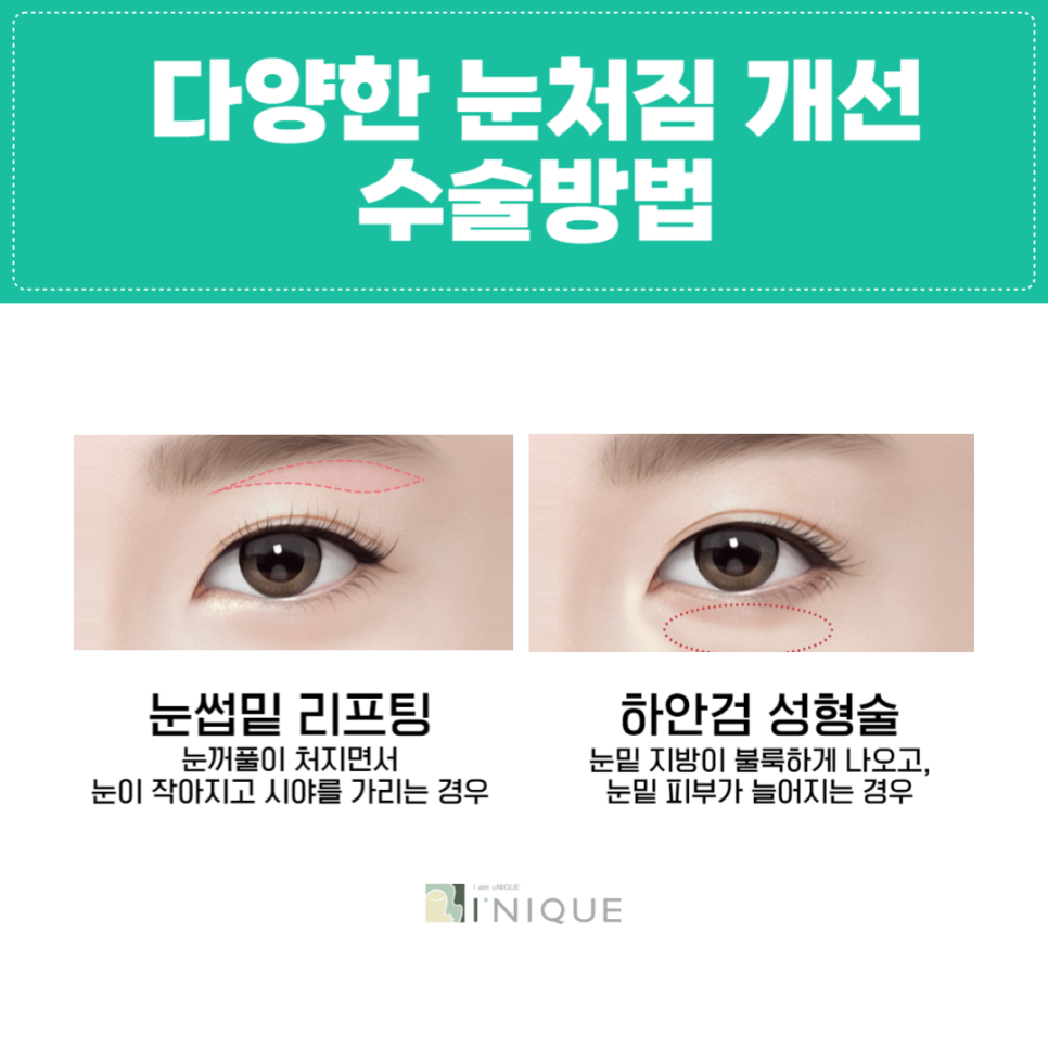 Is Double Eyelid Surgery in Your 50s the Right Choice? image 5