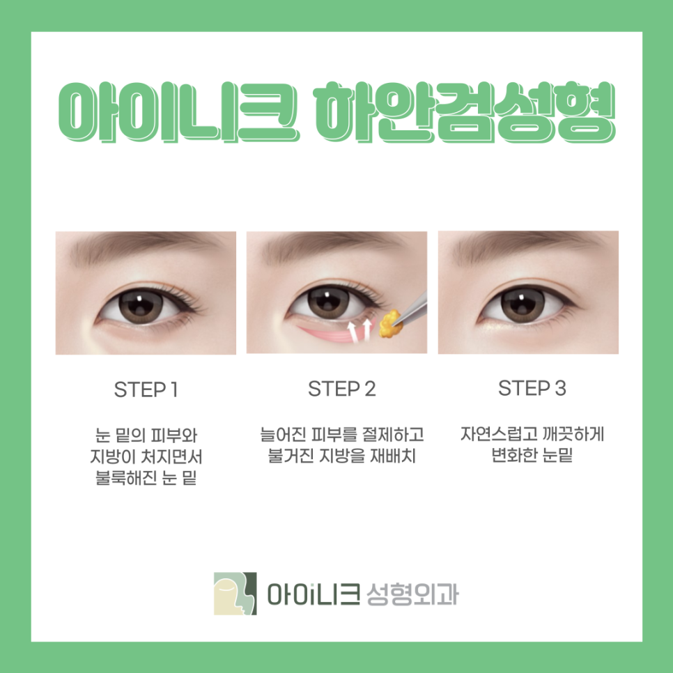 중년눈성형외과 처진 눈 개선하기 관련 이미지 6