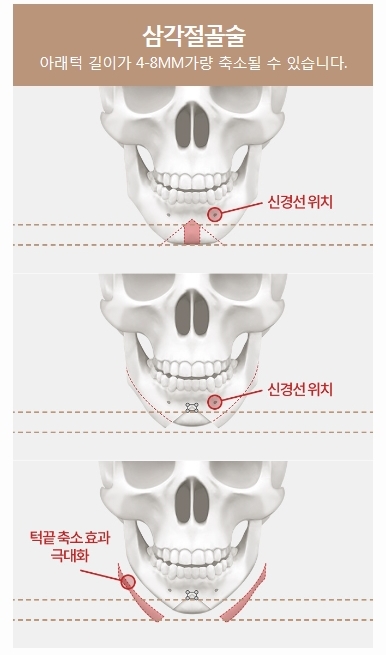 턱끝축소술비용 세련된 내 모습 관련 이미지 4