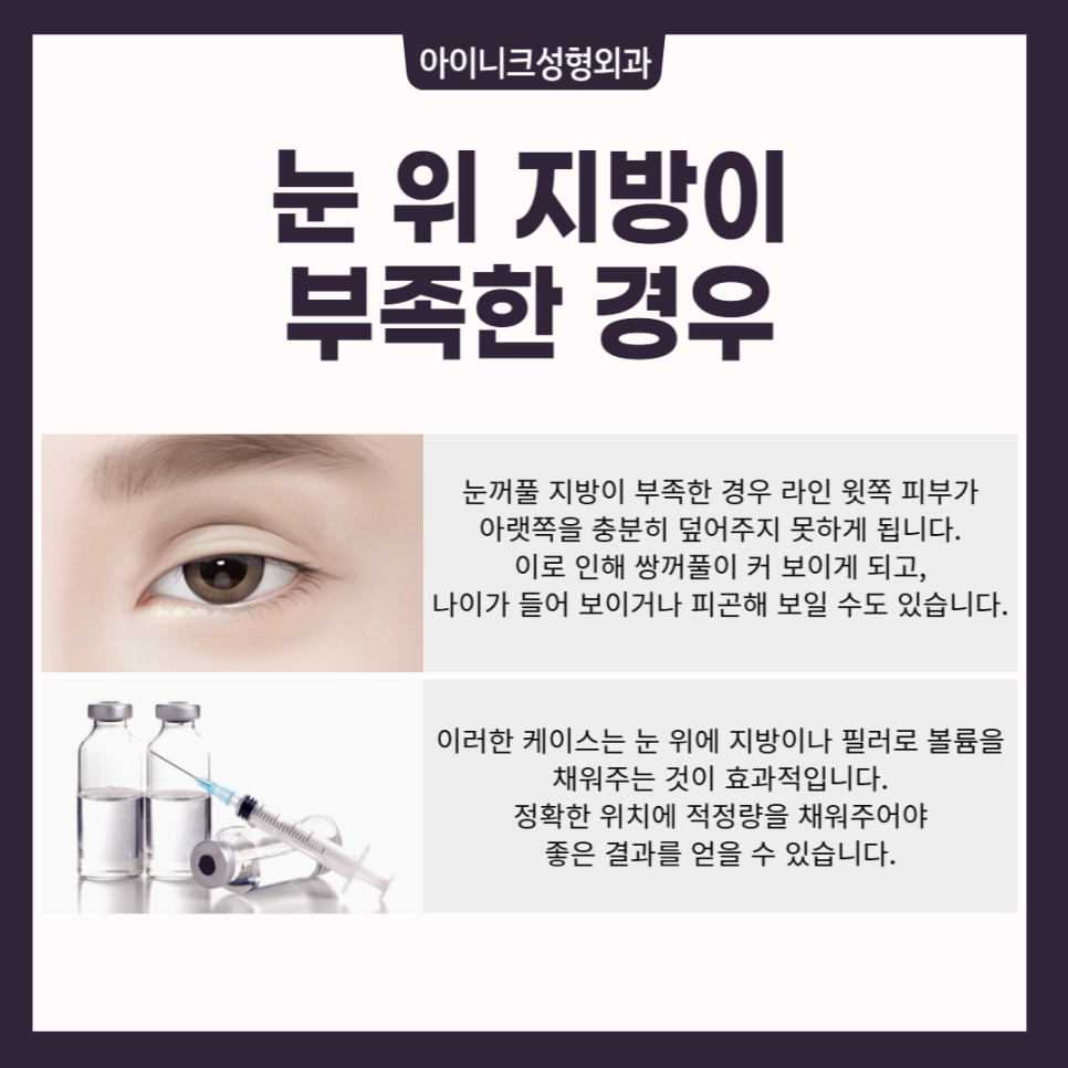 소세지쌍꺼풀재수술, 고민한다면 관련 이미지 6