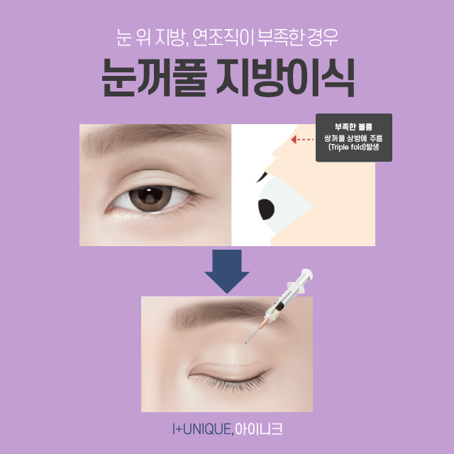 성형의 기본 쌍꺼풀 수술부터 풀린쌍꺼풀, 삼꺼풀 해결 방법까지 모두 알아보기 관련 이미지 5