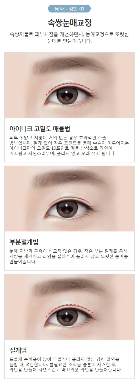 남자속쌍눈매교정 자연스럽고 또렷한 속쌍꺼풀 성형 관련 이미지 4