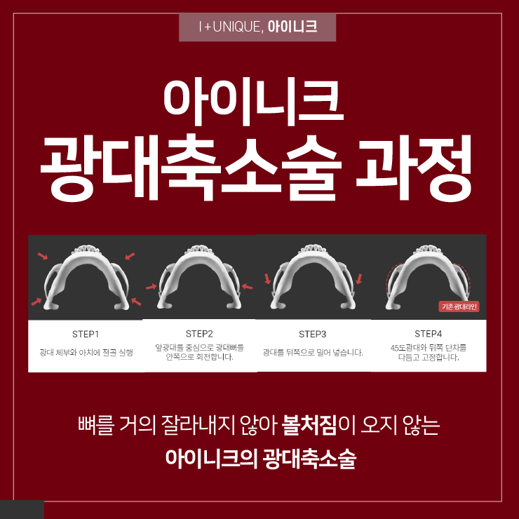 모든 각도에서 예쁘도록 ㅇㅇㄴㅋ 성형 광대축소 관련 이미지 4