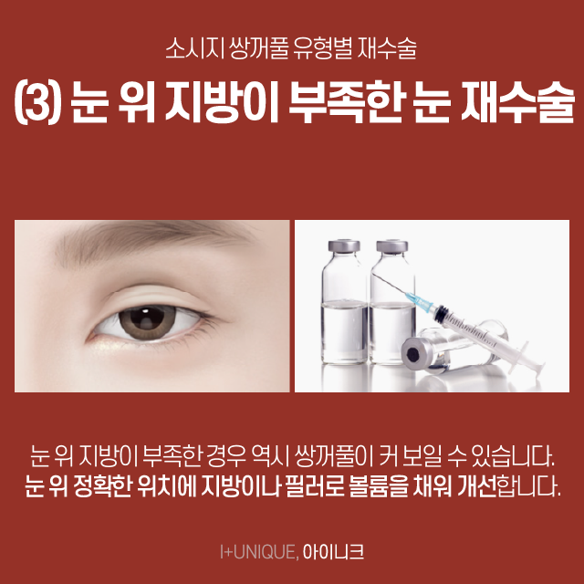 What Should You Do About Uncomfortable Sausage-Like Double Eyelids? image 5