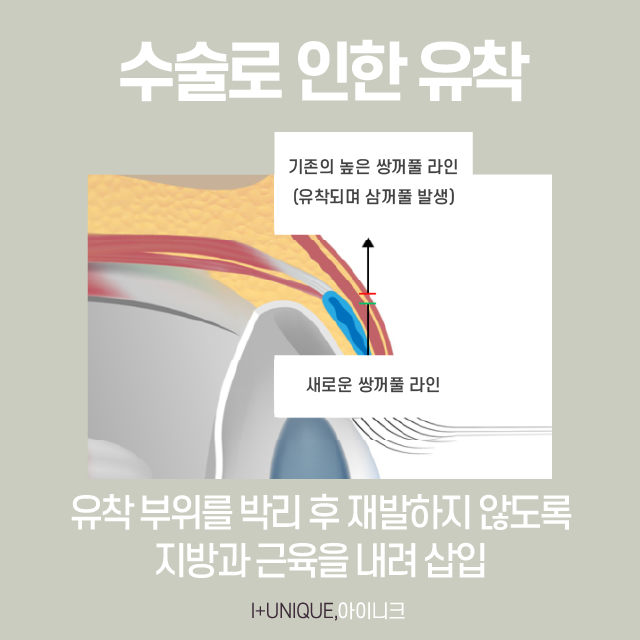삼꺼풀 해결방법 궁금하다면? 관련 이미지 5