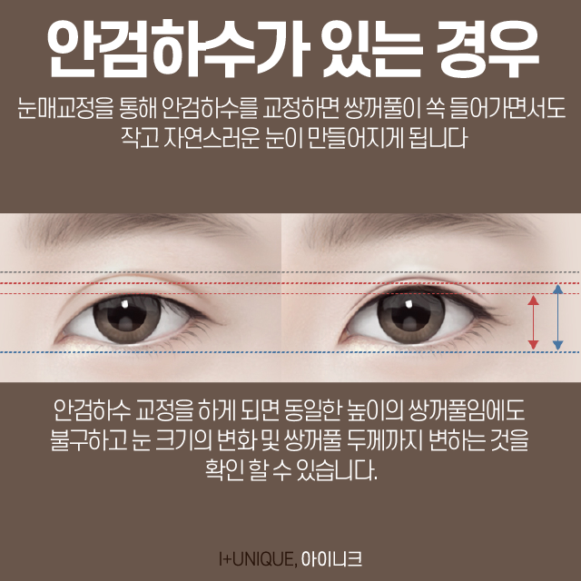 소세지쌍꺼풀, 더이상 속상한 채로 두지말고 아이니크성형외과로 관련 이미지 4